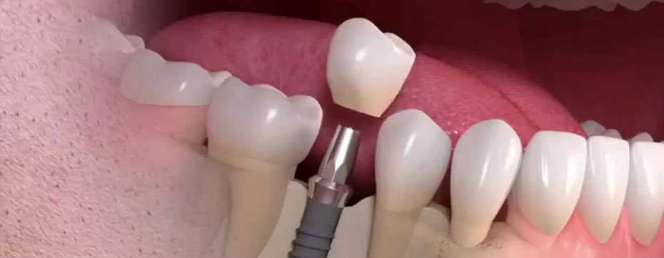 dental implants Delray