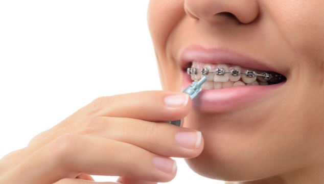 The Importance Of Wearing A Retainer After Orthodontic Treatment